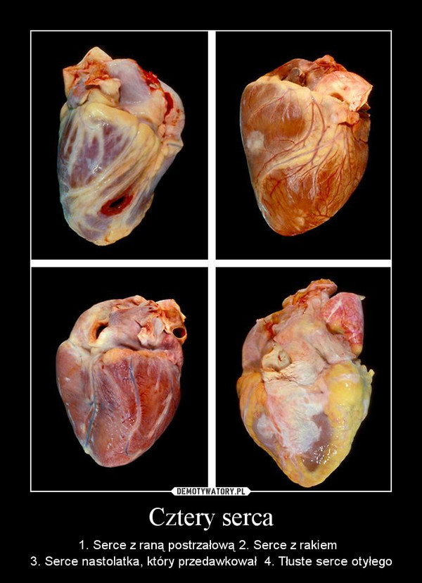 Cztery serca – 1. Serce z raną postrzałową 2. Serce z rakiem  3. Serce nastolatka, który przedawkował  4. Tłuste serce otyłego 